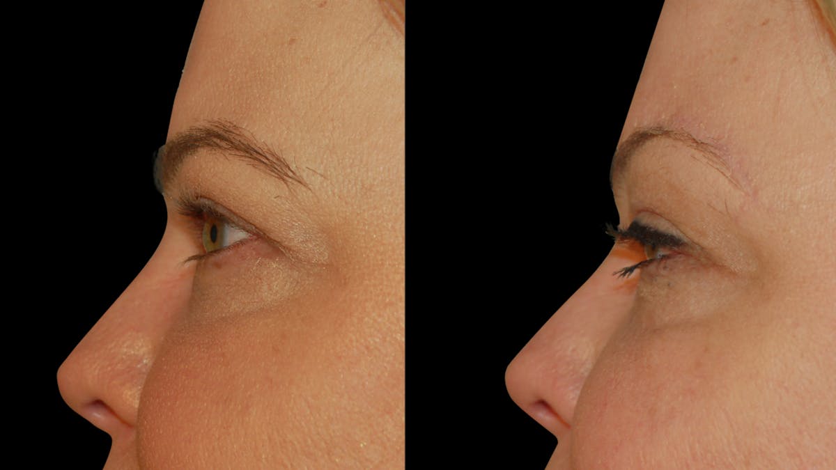 Brow Lift Before & After Gallery - Patient 395482 - Image 8