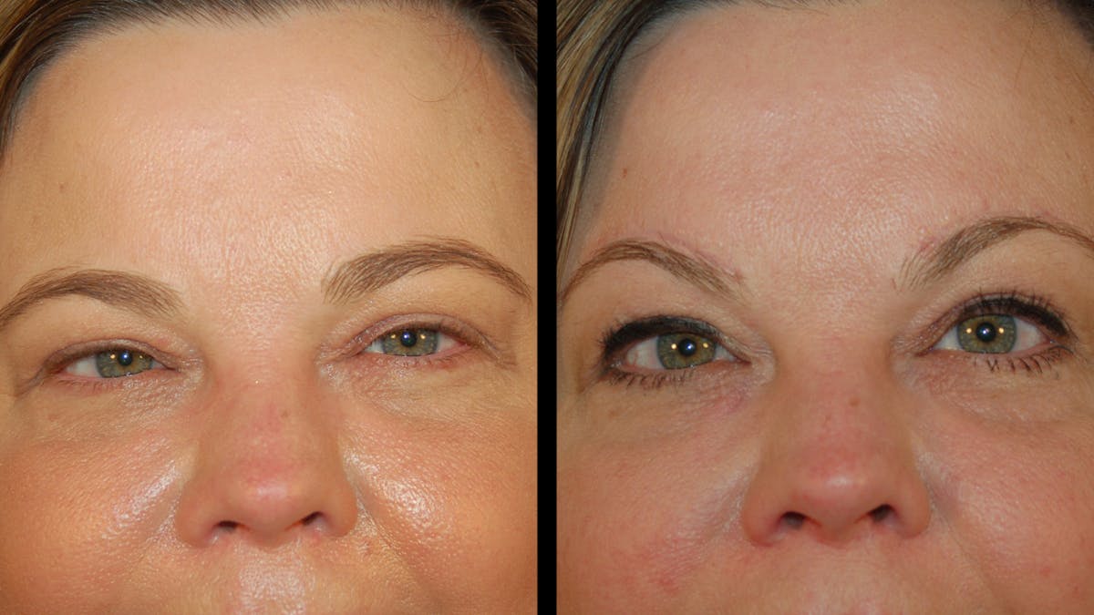 Brow Lift Before & After Gallery - Patient 395482 - Image 9