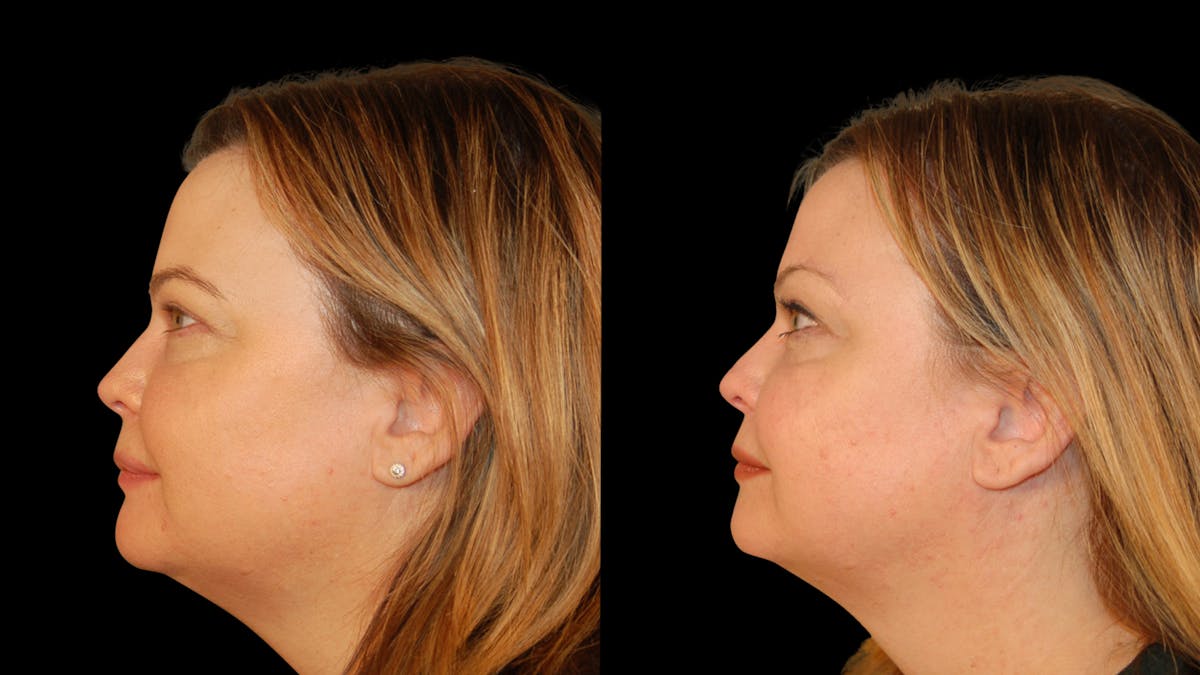 Brow Lift Before & After Gallery - Patient 395482 - Image 3