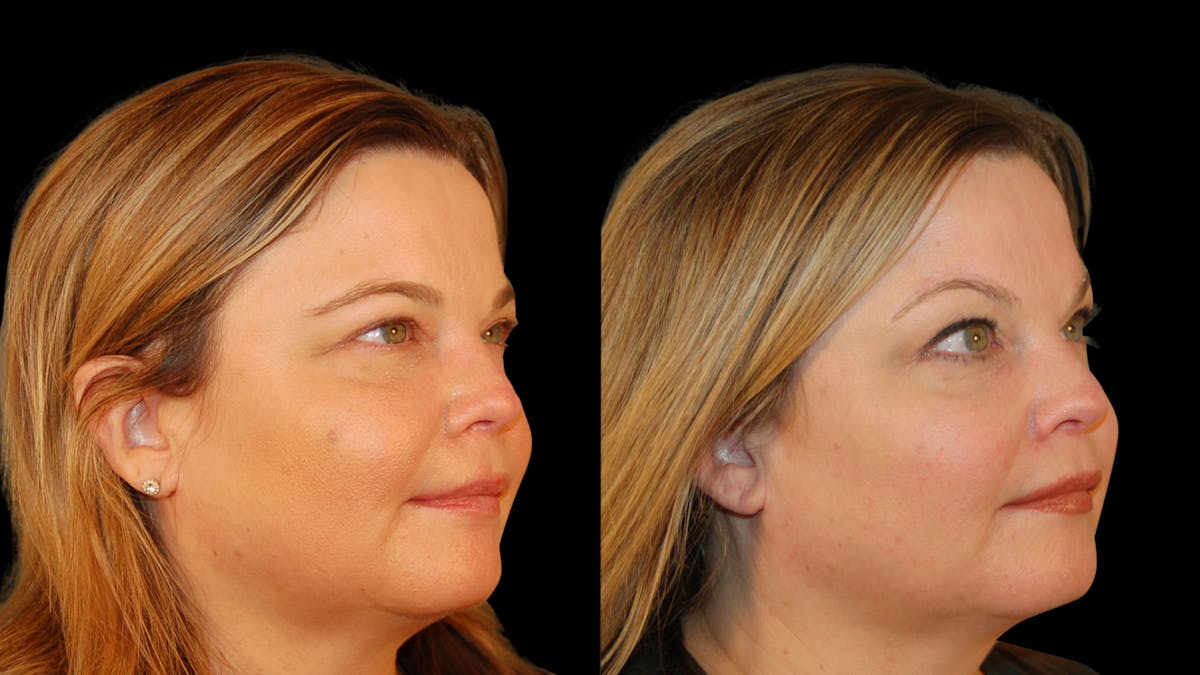 Brow Lift Before & After Gallery - Patient 395482 - Image 4