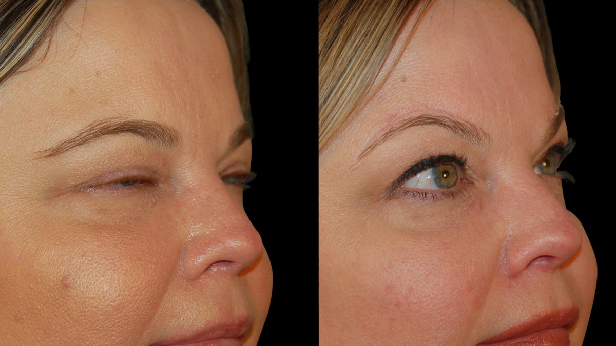 Brow Lift Before & After Gallery - Patient 395482 - Image 10