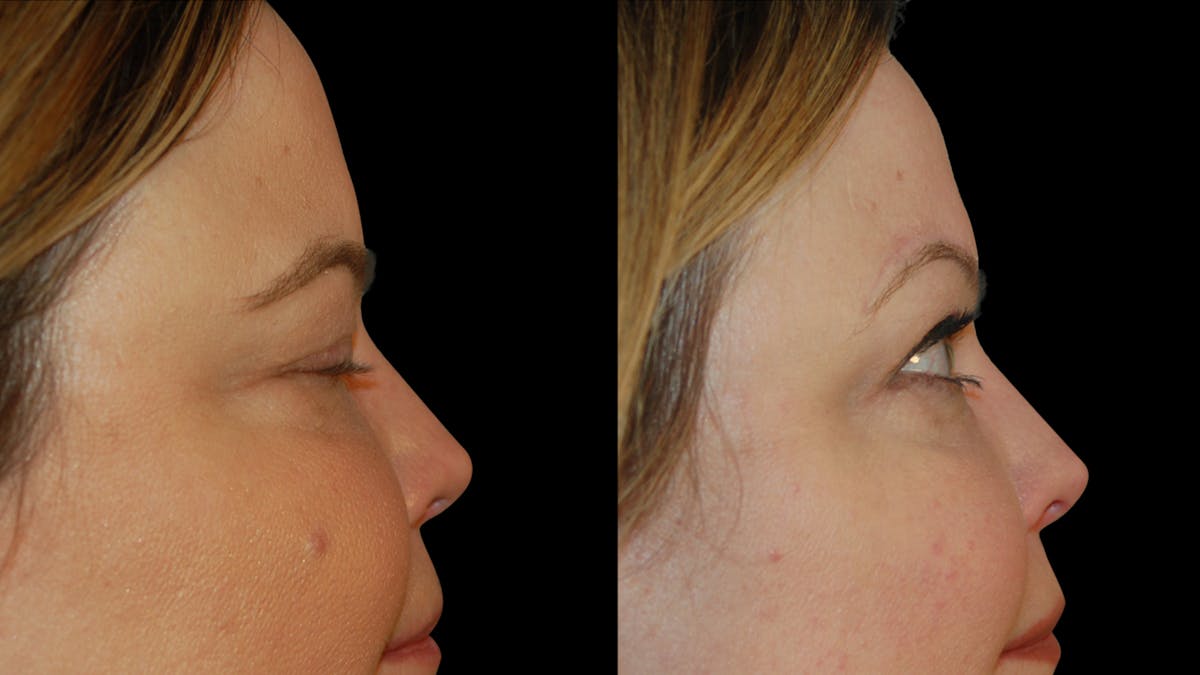 Brow Lift Before & After Gallery - Patient 395482 - Image 6