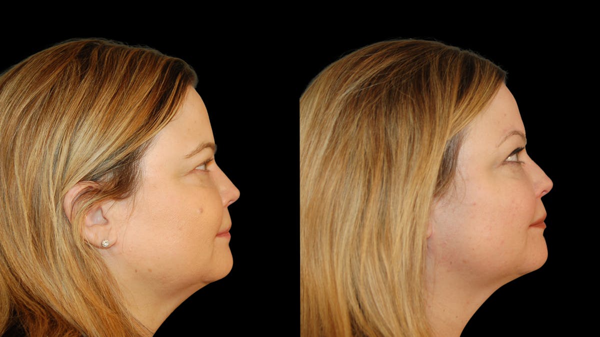 Brow Lift Before & After Gallery - Patient 395482 - Image 5