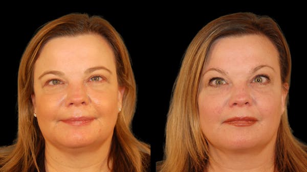 Brow Lift Before & After Gallery - Patient 395482 - Image 1