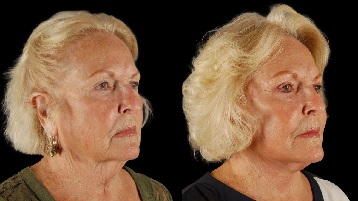 Deep Plane Facelift Before & After Gallery - Patient 259127 - Image 2