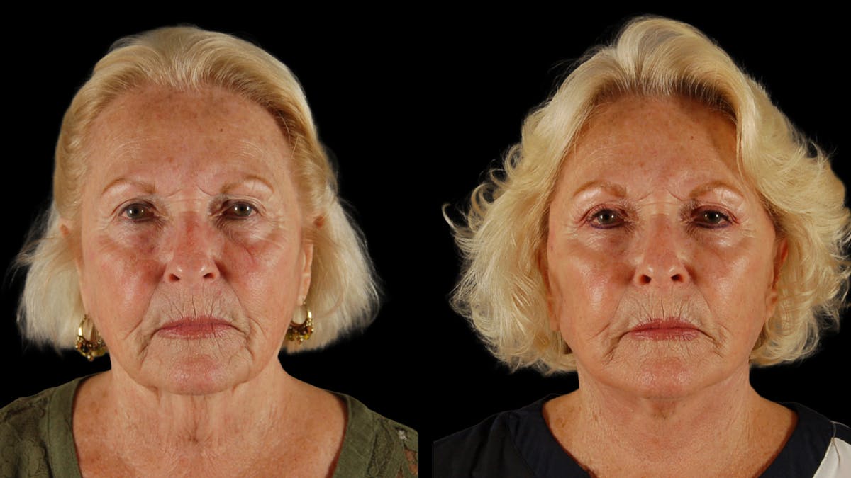 Deep Plane Facelift Before & After Gallery - Patient 259127 - Image 1