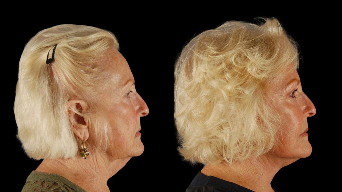 Deep Plane Facelift Before & After Gallery - Patient 259127 - Image 3