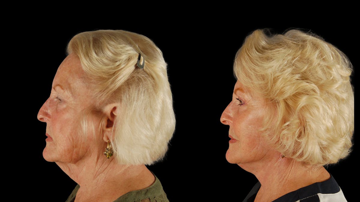 Deep Plane Facelift Before & After Gallery - Patient 259127 - Image 4