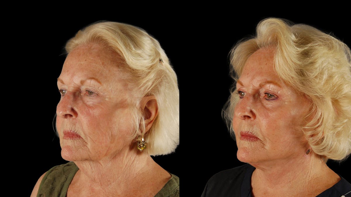 Deep Plane Facelift Before & After Gallery - Patient 259127 - Image 5