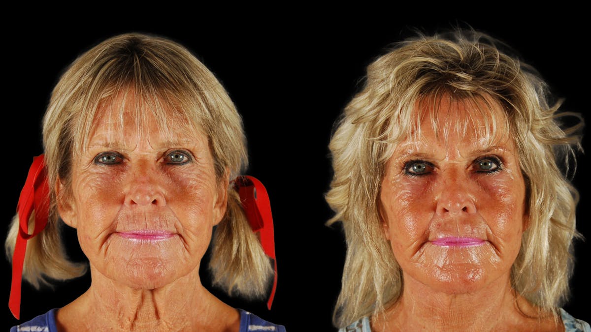 Deep Plane Facelift Before & After Gallery - Patient 261186 - Image 1