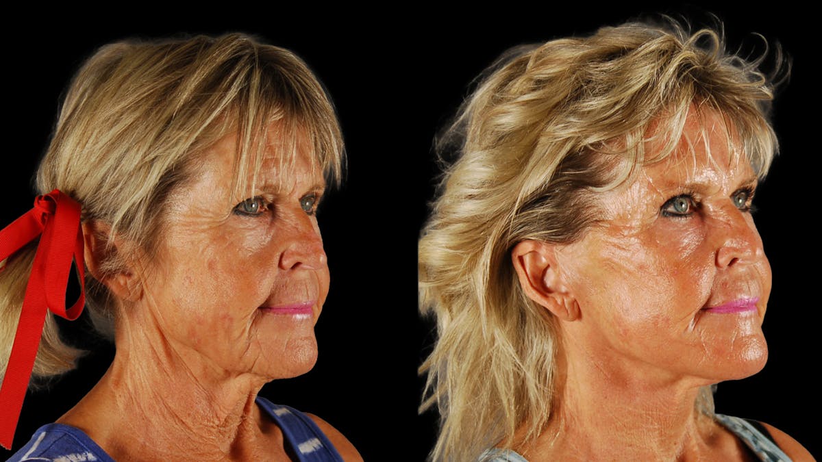 Deep Plane Facelift Before & After Gallery - Patient 261186 - Image 2