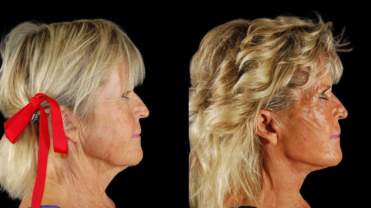 Deep Plane Facelift Before & After Gallery - Patient 261186 - Image 3