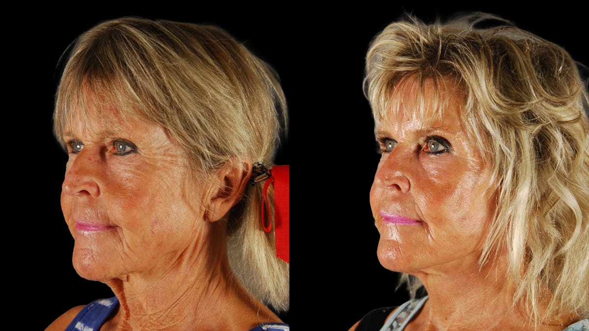 Deep Plane Facelift Before & After Gallery - Patient 261186 - Image 4