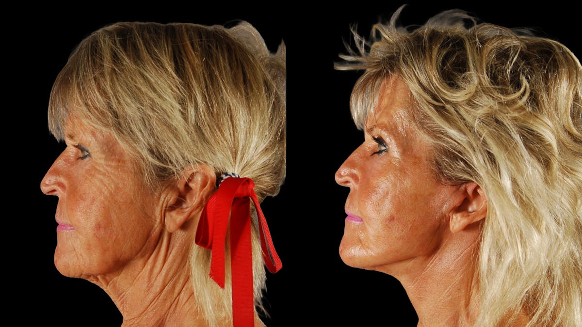 Deep Plane Facelift Before & After Gallery - Patient 261186 - Image 5