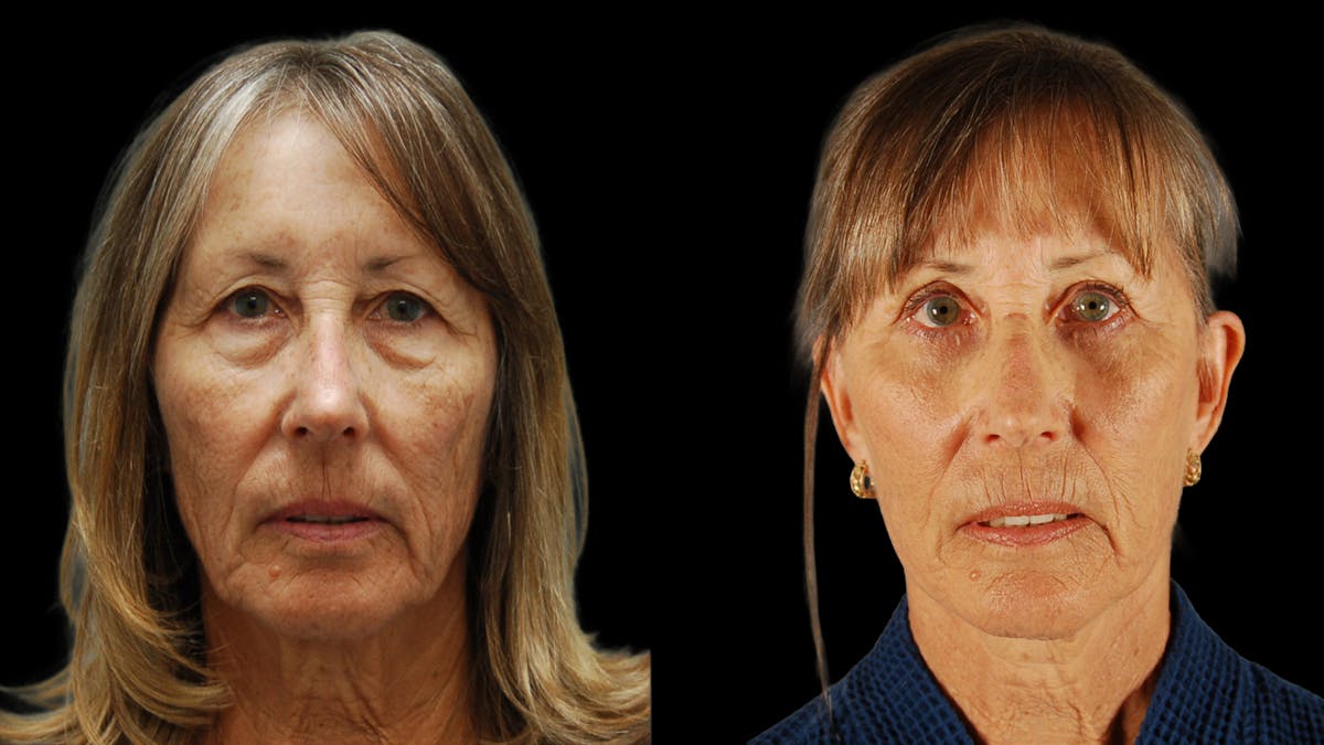 Deep Plane Facelift Before & After Gallery - Patient 329578 - Image 1