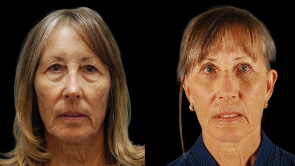 Deep Plane Facelift Before & After Gallery - Patient 329578 - Image 1