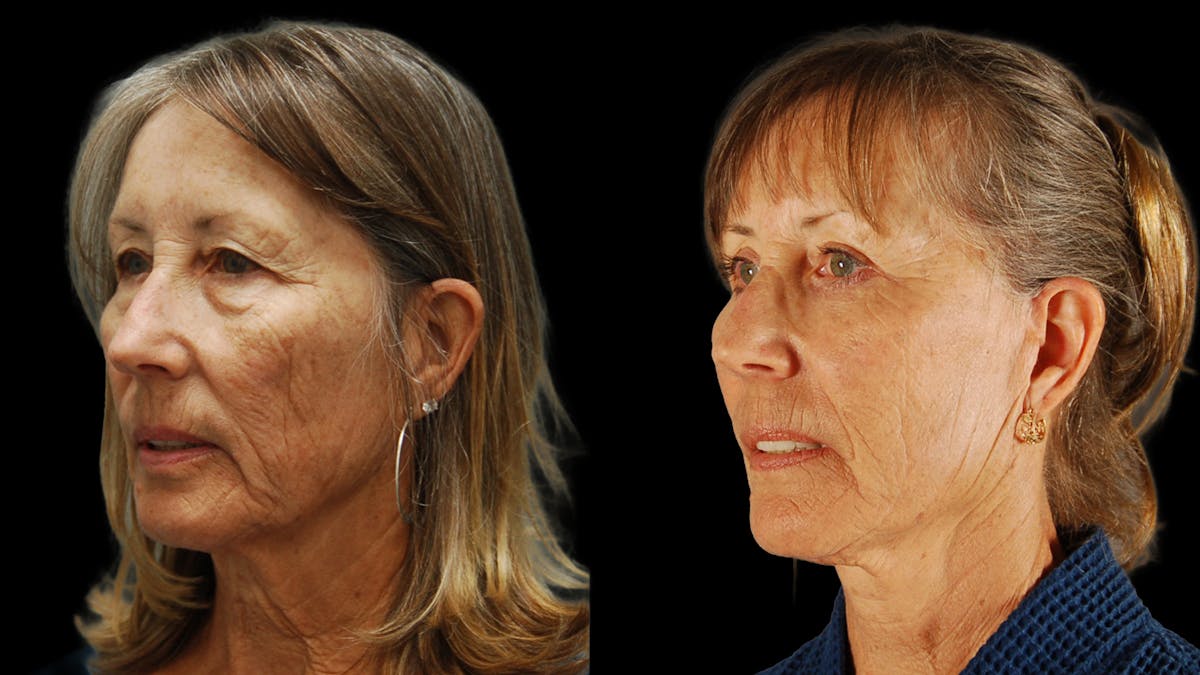 Deep Plane Facelift Before & After Gallery - Patient 329578 - Image 2