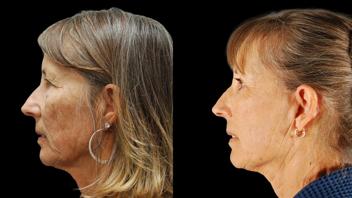 Deep Plane Facelift Before & After Gallery - Patient 329578 - Image 3