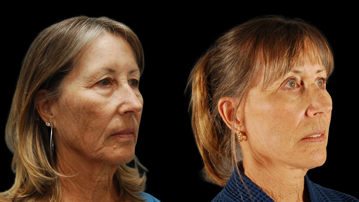 Deep Plane Facelift Before & After Gallery - Patient 329578 - Image 4