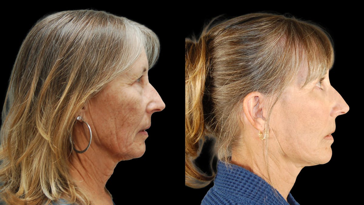 Deep Plane Facelift Before & After Gallery - Patient 329578 - Image 5