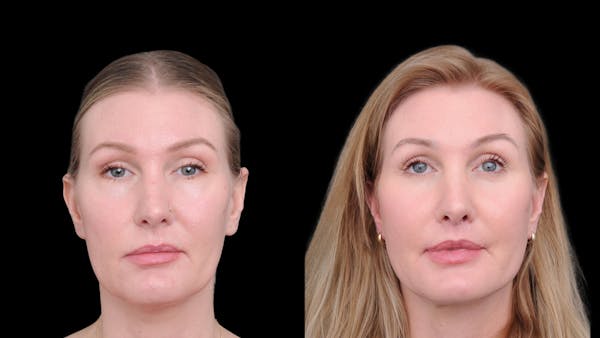 Deep Plane Facelift Before & After Gallery - Patient 231133 - Image 1