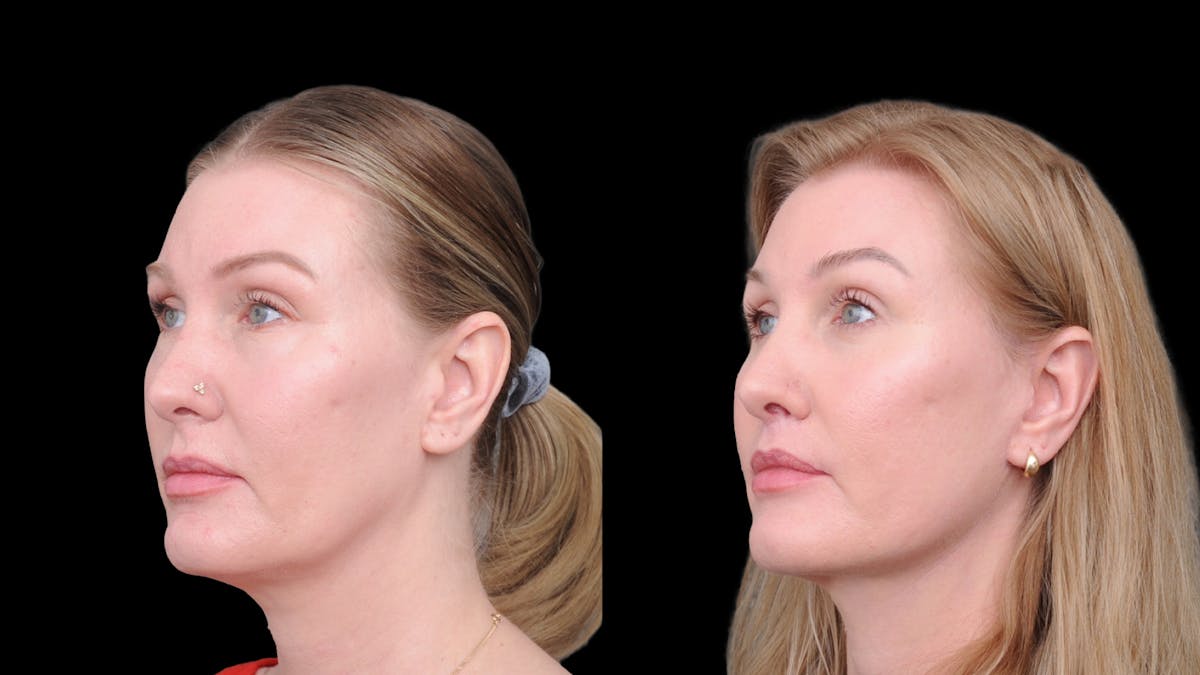 Deep Plane Facelift Before & After Gallery - Patient 231133 - Image 2