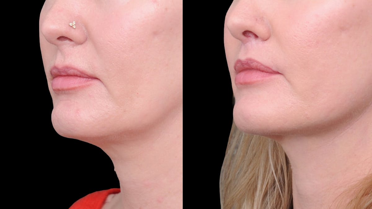 Deep Plane Facelift Before & After Gallery - Patient 231133 - Image 3