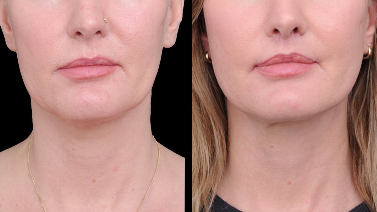 Deep Plane Facelift Before & After Gallery - Patient 231133 - Image 4