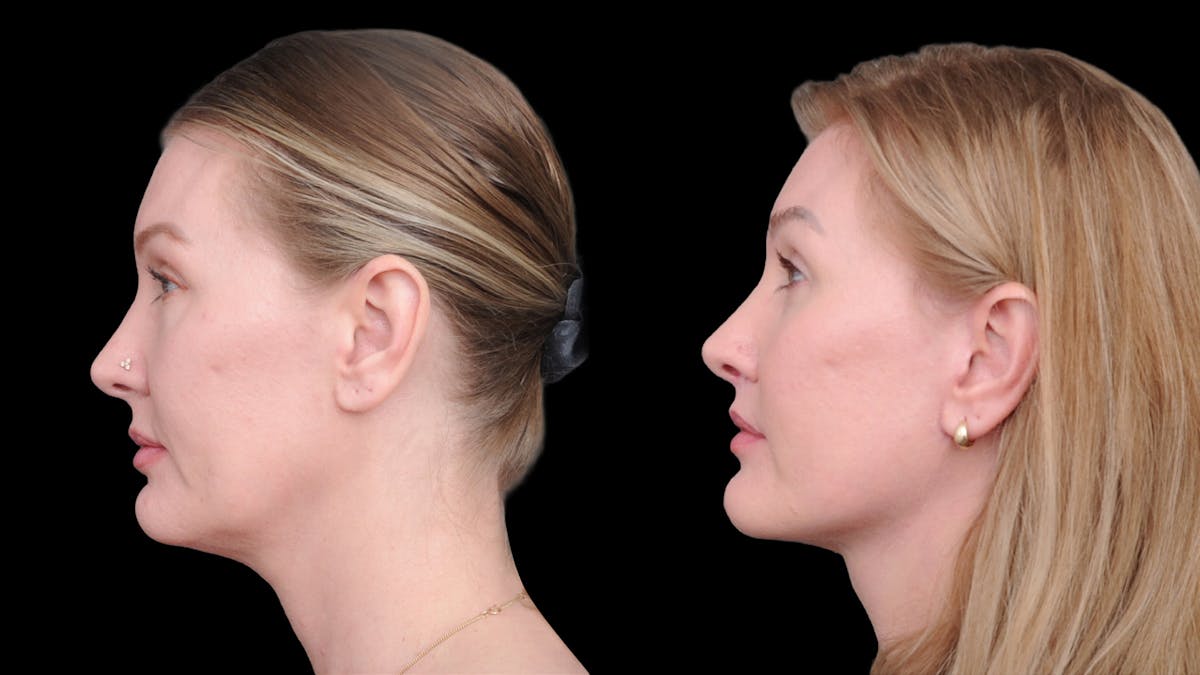 Deep Plane Facelift Before & After Gallery - Patient 231133 - Image 5