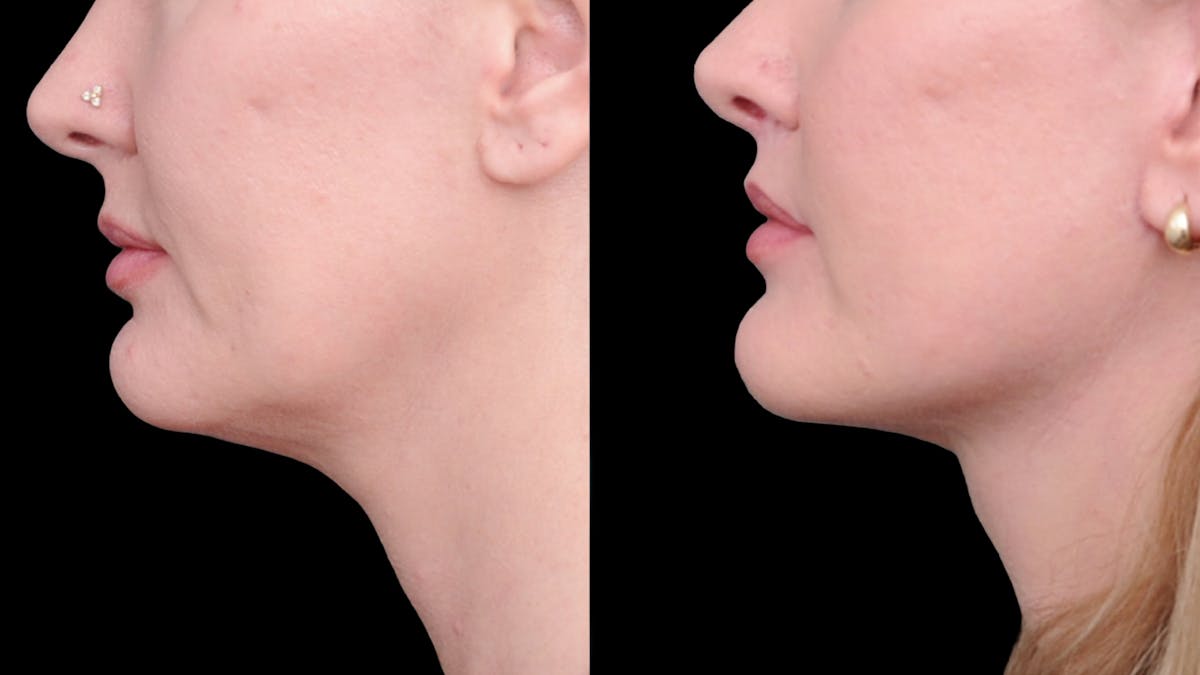 Deep Plane Facelift Before & After Gallery - Patient 231133 - Image 6