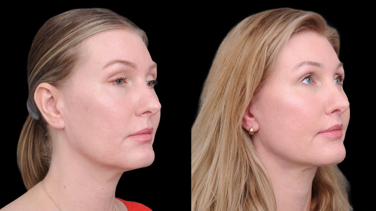 Deep Plane Facelift Before & After Gallery - Patient 231133 - Image 7