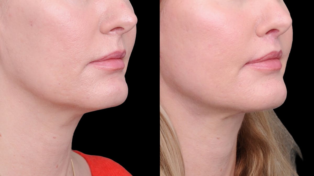 Deep Plane Facelift Before & After Gallery - Patient 231133 - Image 8