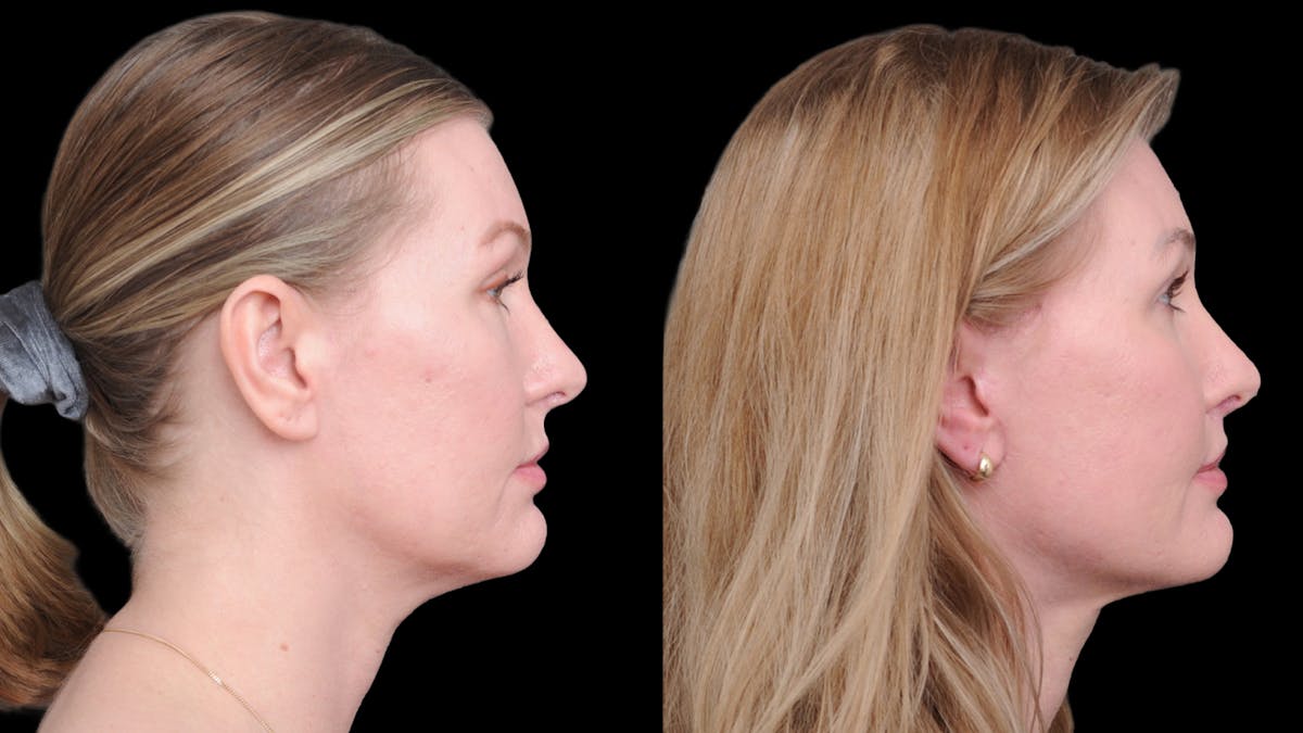 Deep Plane Facelift Before & After Gallery - Patient 231133 - Image 9