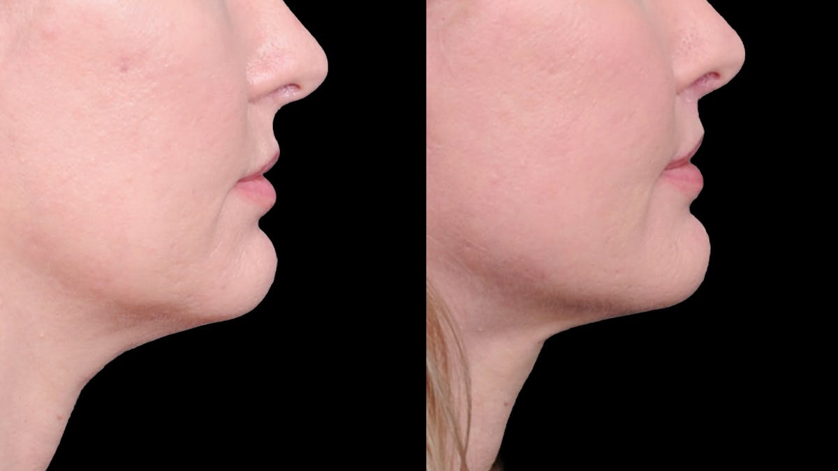 Deep Plane Facelift Before & After Gallery - Patient 231133 - Image 10