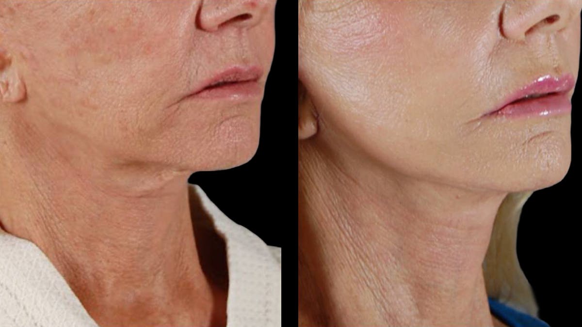 Deep Plane Facelift Before & After Gallery - Patient 394451 - Image 6