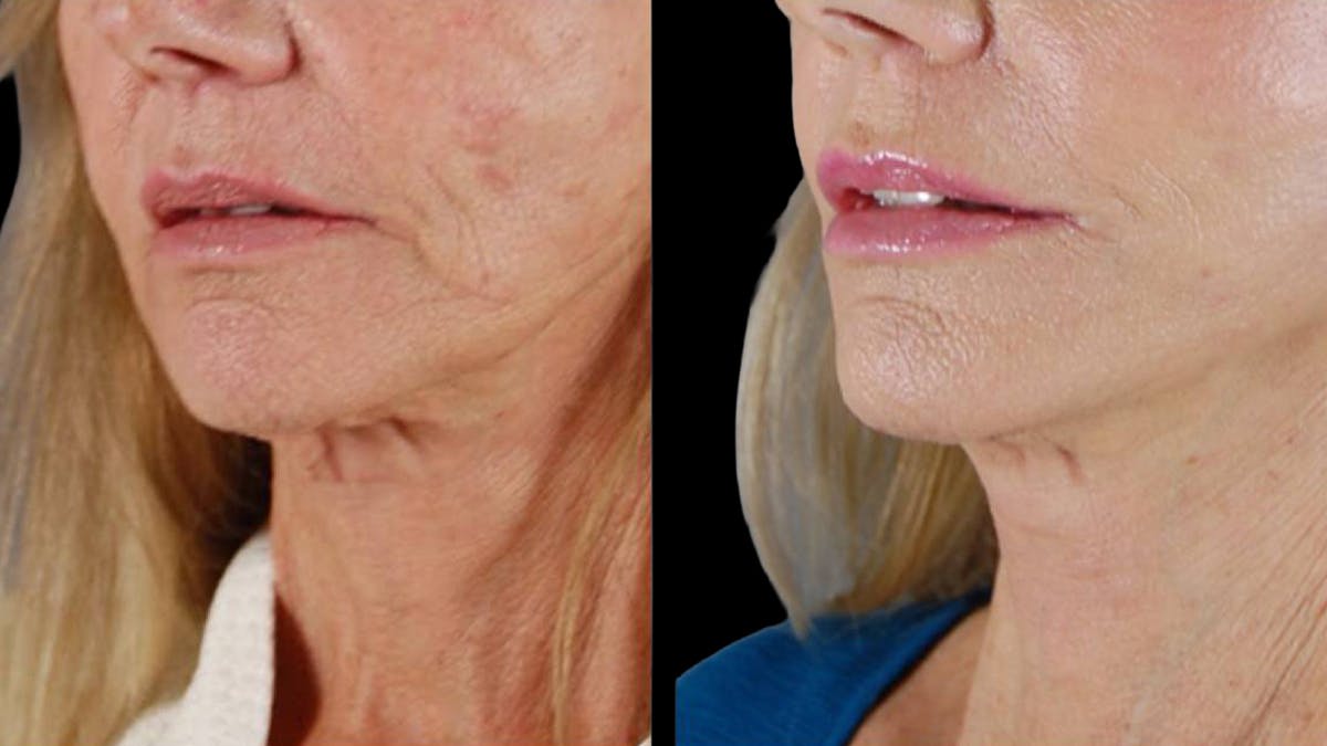 Deep Plane Facelift Before & After Gallery - Patient 394451 - Image 8