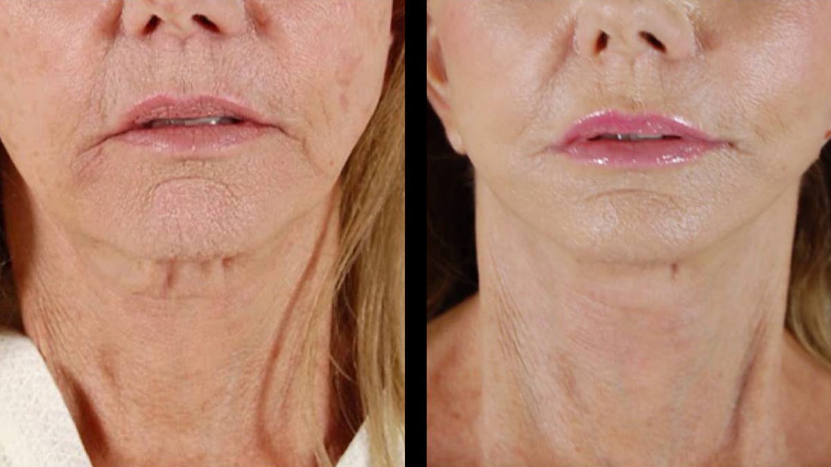 Deep Plane Facelift Before & After Gallery - Patient 394451 - Image 7