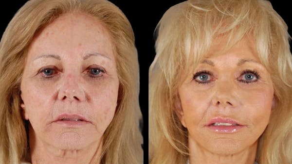 Deep Plane Facelift Before & After Gallery - Patient 394451 - Image 1