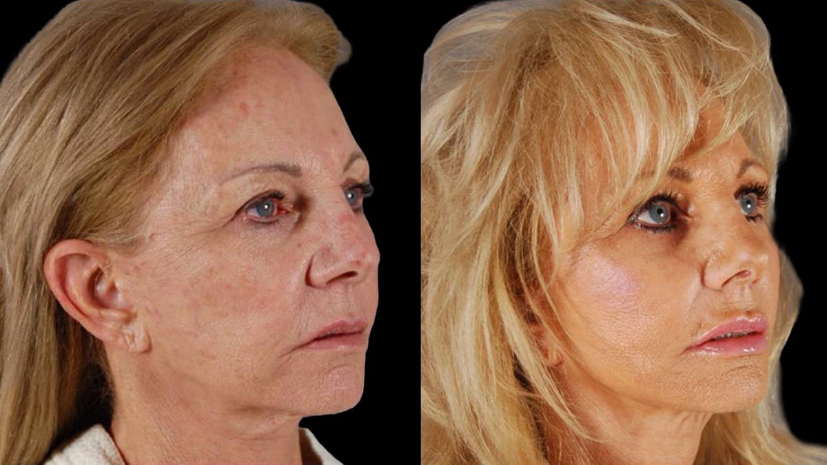 Deep Plane Facelift Before & After Gallery - Patient 394451 - Image 2