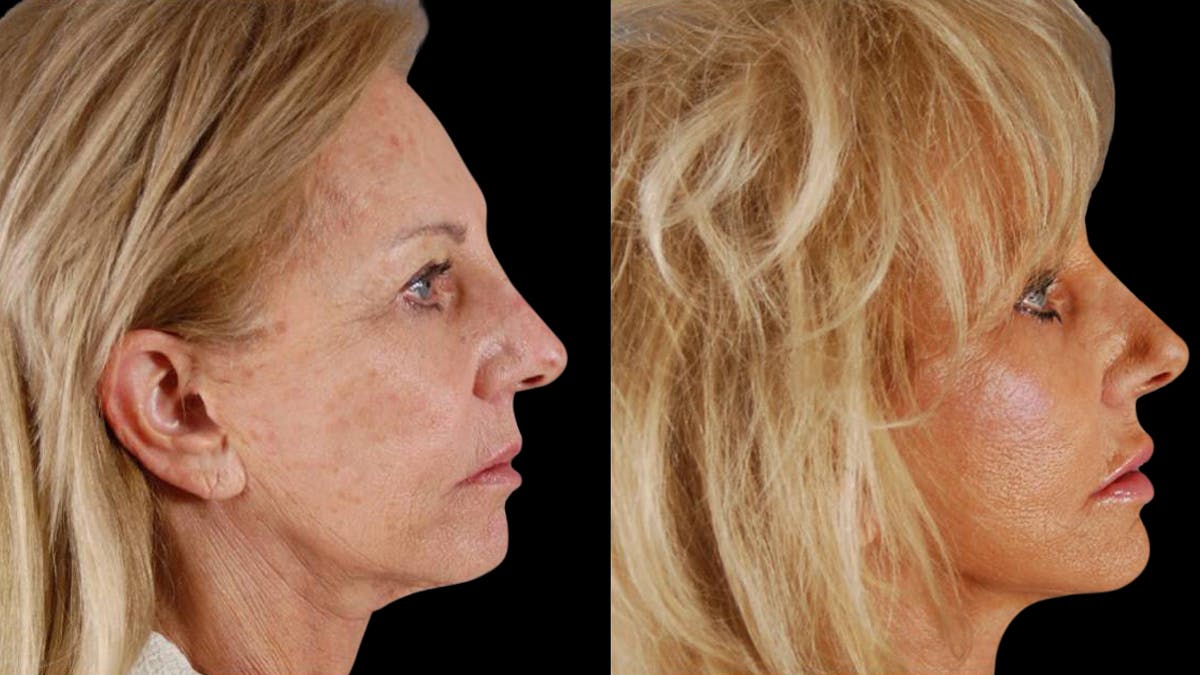 Deep Plane Facelift Before & After Gallery - Patient 394451 - Image 3