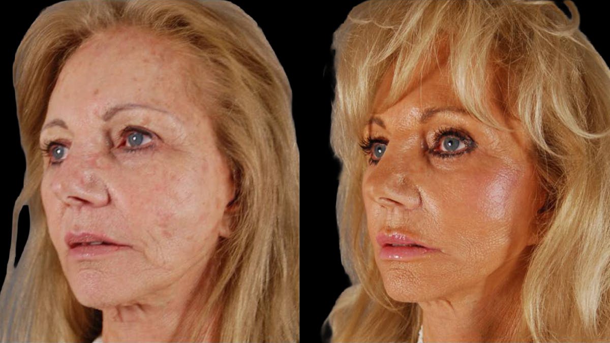 Deep Plane Facelift Before & After Gallery - Patient 394451 - Image 4