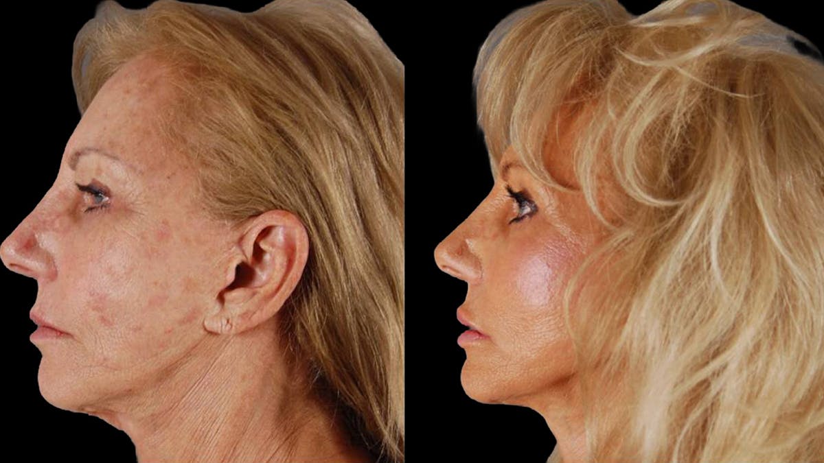 Deep Plane Facelift Before & After Gallery - Patient 394451 - Image 5