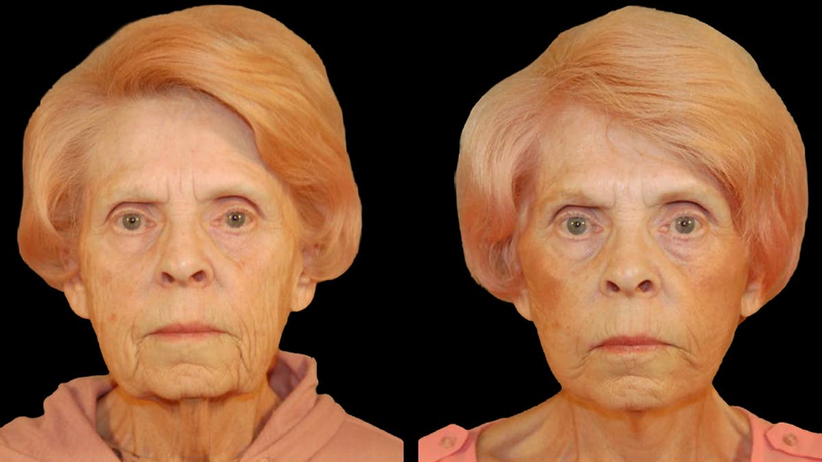 Deep Plane Facelift Before & After Gallery - Patient 249958 - Image 1