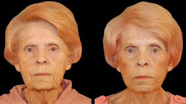 Deep Plane Facelift Before & After Gallery - Patient 249958 - Image 1