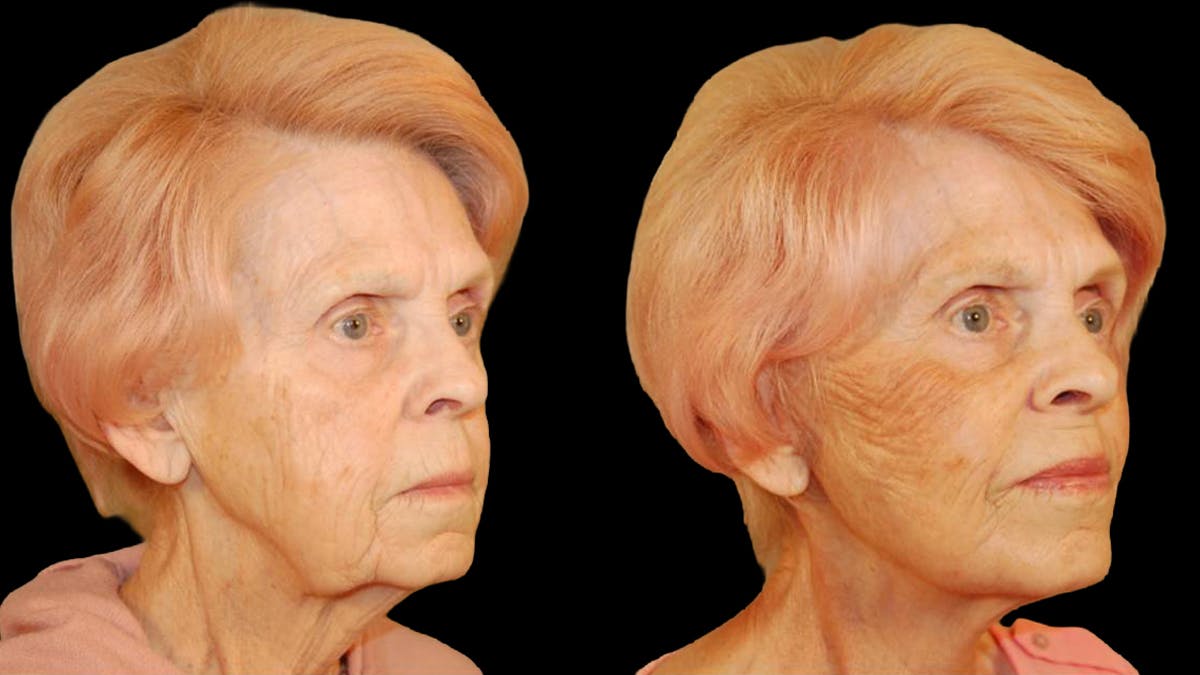 Deep Plane Facelift Before & After Gallery - Patient 249958 - Image 2