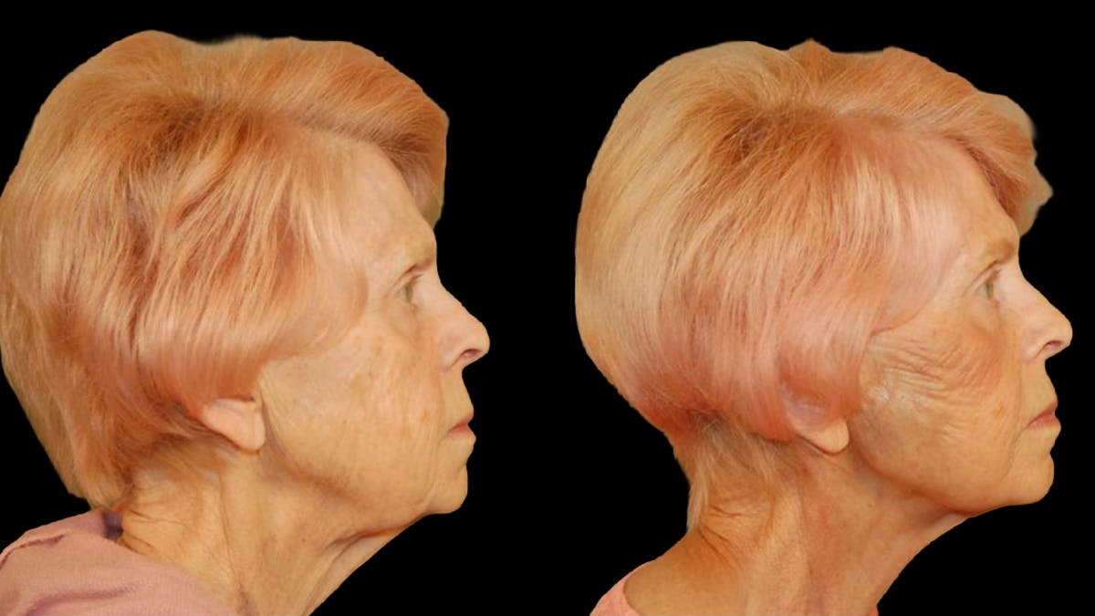 Deep Plane Facelift Before & After Gallery - Patient 249958 - Image 3