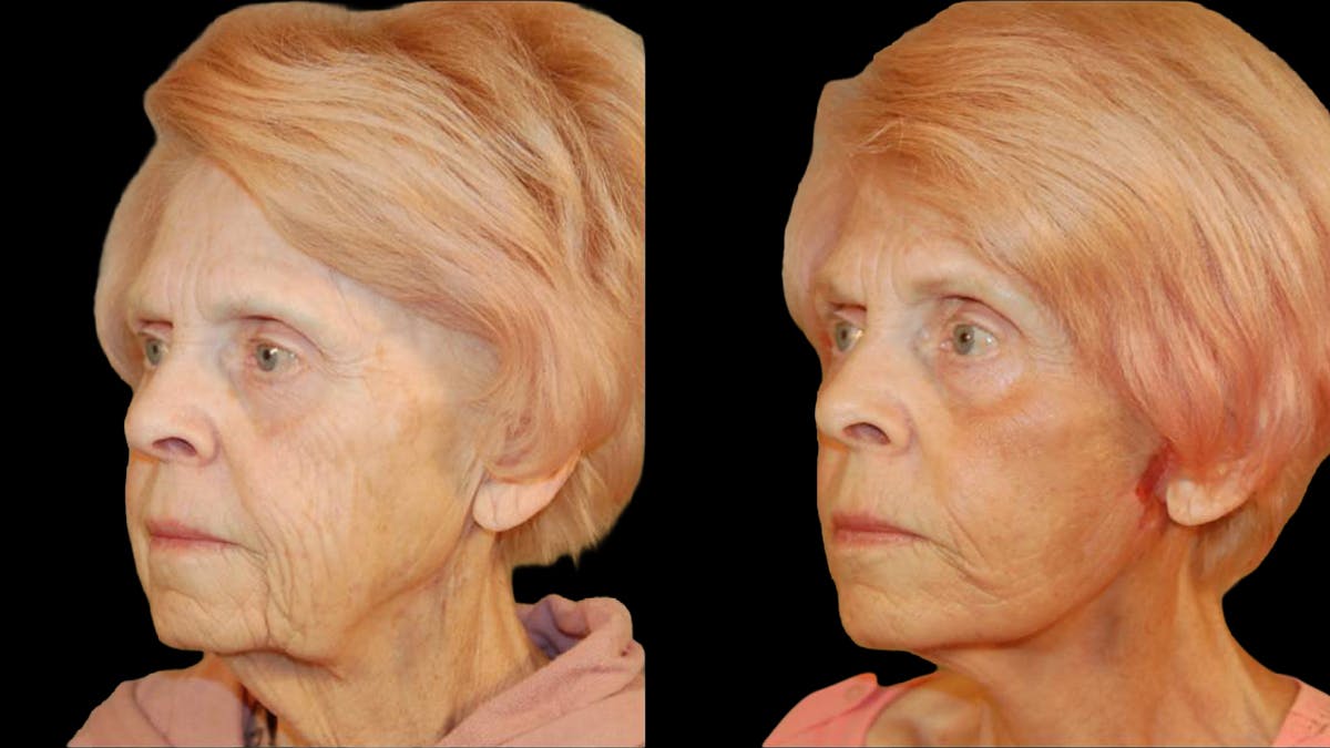 Deep Plane Facelift Before & After Gallery - Patient 249958 - Image 4