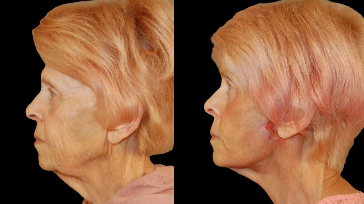 Deep Plane Facelift Before & After Gallery - Patient 249958 - Image 5