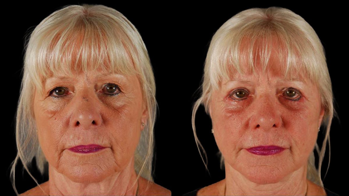 Neck Lift Before & After Gallery - Patient 955838 - Image 1