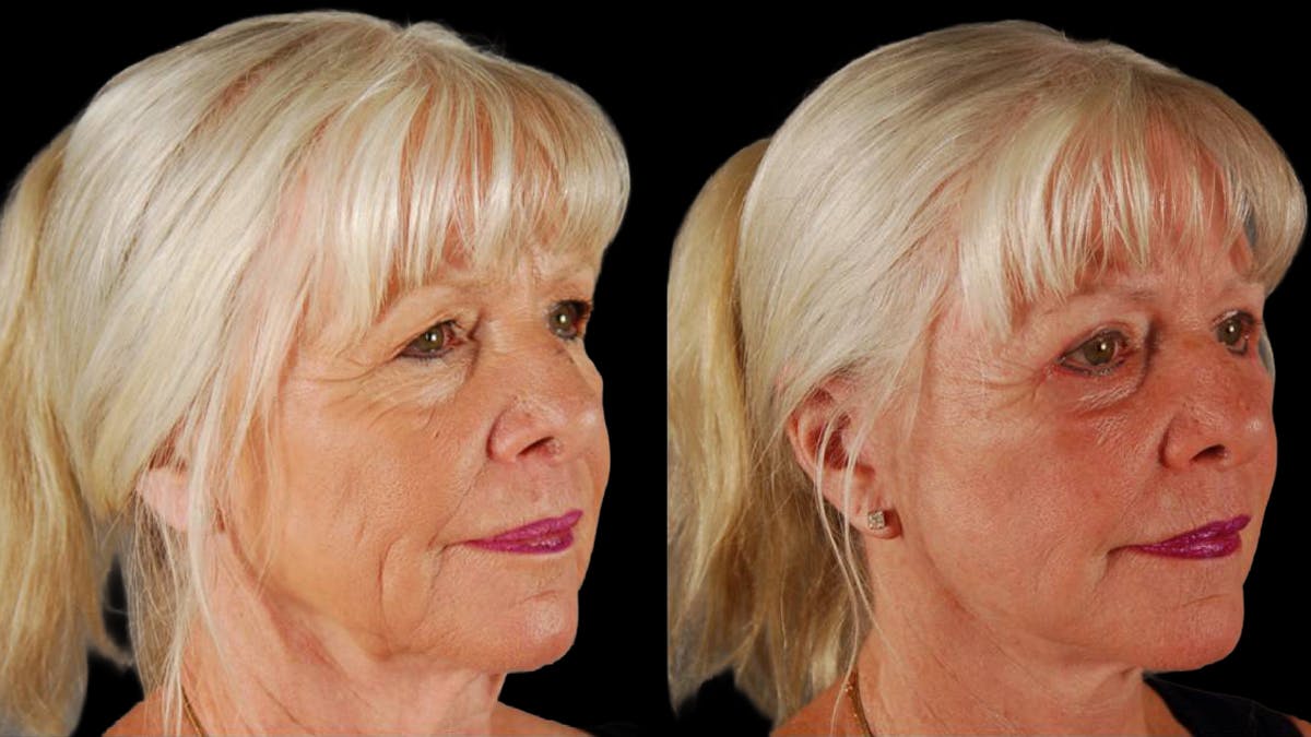 Neck Lift Before & After Gallery - Patient 955838 - Image 2